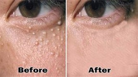 How To Remove The Milia Milk Spots From Your Face Naturally!!!