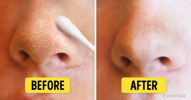 The Toothbrush Remedy To Get Rid Of Blackheads In A Few Minutes