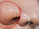 Remove BLACKHEADS / WHITEHEADS At Home In Just 2 Minutes (Best And Easy Way)