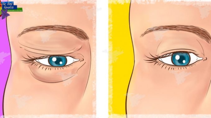 Natural Remedy for Sagging Eyelids