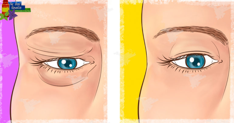 Natural Remedy for Sagging Eyelids