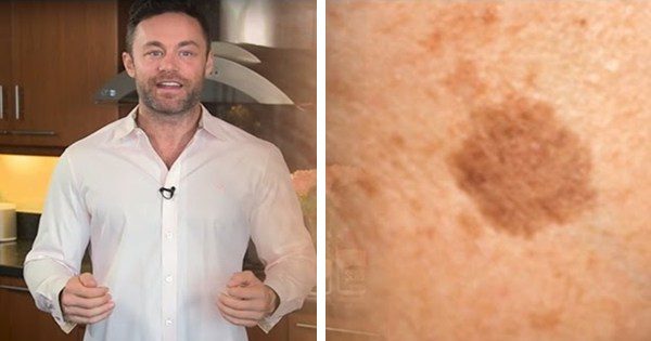 Brown Spots Brown Spots