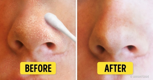How to get rid of Blackheads naturally