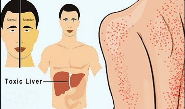 Signs of Liver Damage Signs of Liver Damage