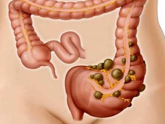 natural remedies for diverticulosis that are worth sharing