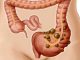 natural remedies for diverticulosis that are worth sharing