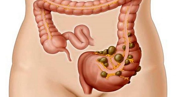 natural remedies for diverticulosis that are worth sharing