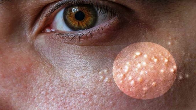 7 Remedies to Get Rid of Milk Spots Naturally 7 Remedies to Get Rid of Milk Spots Naturally