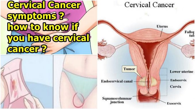 Cervical Cancer