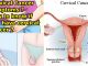 Cervical Cancer