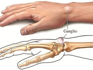 How To Get Rid Of Ganglion Cysts With This Home Remedies