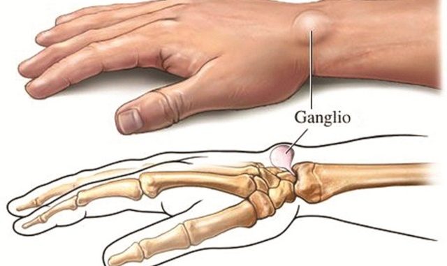 How To Get Rid Of Ganglion Cysts With This Home Remedies