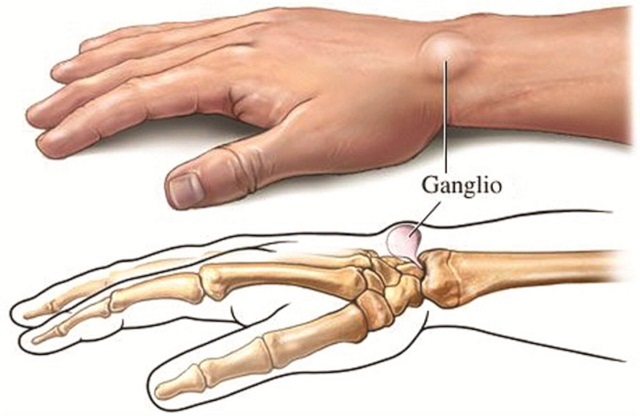 How To Get Rid Of Ganglion Cysts With This Home Remedies