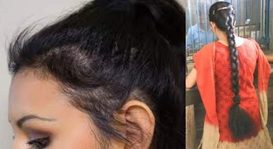 She Was Getting Bald So Fast But Then Just One Thing Stopped It And In Just 2 Months Everyone Was Surprised By Her Tremendous Hair Growth 2
