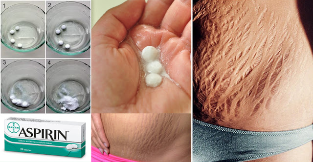 Here Is How To Use Aspirin To Get Rid Of Stretch Marks Easily and Fast! Here Is How To Use Aspirin To Get Rid Of Stretch Marks Easily and Fast!