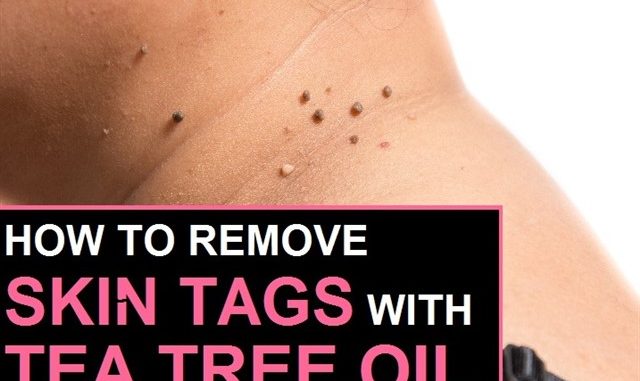 How To Remove Skin Tags With Tea Tree Oil?