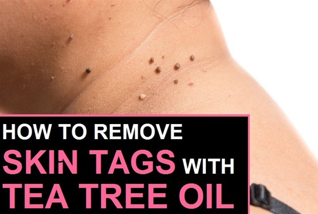 How To Remove Skin Tags With Tea Tree Oil?