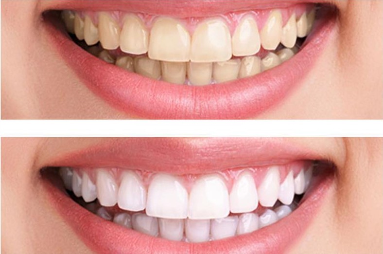 teeth whitening