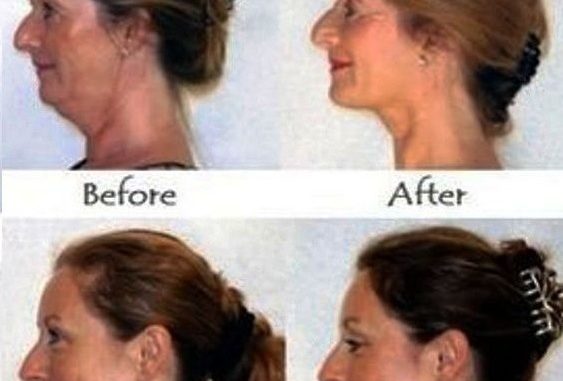 FORGET BOTOX: HERE’S HOW TO STRENGTHEN SAGGY CHEEKS, ELIMINATE DOUBLE CHIN AND LOOK YEARS YOUNGER NATURALLY