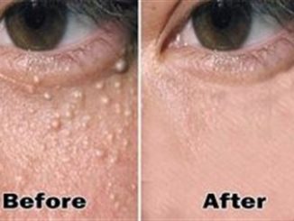 How To Remove The Milia Milk Spots From Your Face Naturally!!!