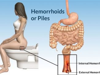 HERE’S HOW TO GET RID OF HEMORRHOIDS AT YOUR HOME