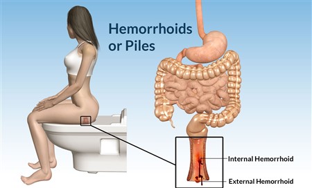 HERE’S HOW TO GET RID OF HEMORRHOIDS AT YOUR HOME