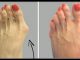 Why Do Doctors Keep This Simple Recipe Away From The Public? Here’s How To Get Rid Of Bunions Completely Natural!