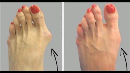 Why Do Doctors Keep This Simple Recipe Away From The Public? Here’s How To Get Rid Of Bunions Completely Natural!