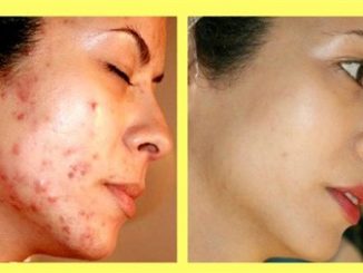 You don't have to spend much to remove pimples