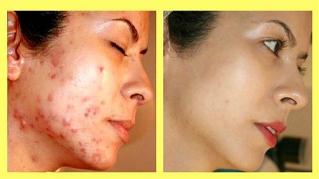 You don’t have to spend much to remove pimples