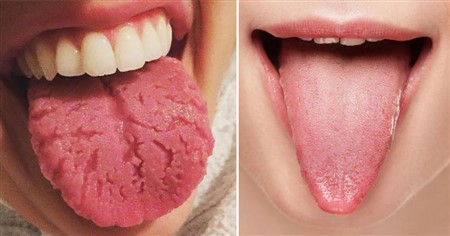 WHAT YOUR TONGUE IS TRYING TO TELL YOU ABOUT YOUR HEALTH