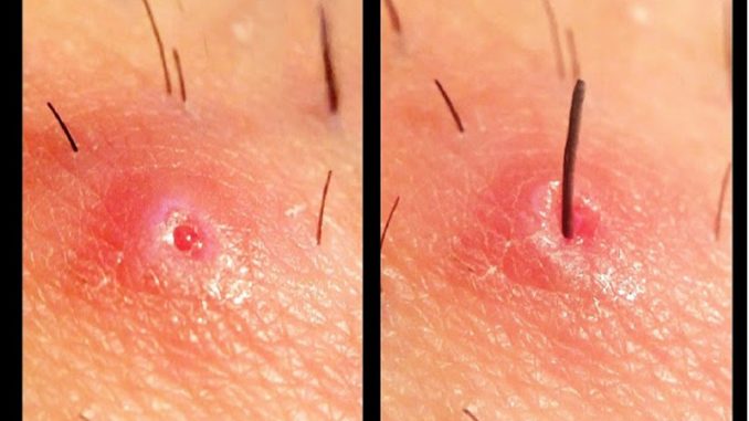 How to Get Rid of Ingrown Hair ?