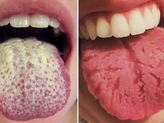 7 Tongue Disorders You Need to Beware of
