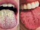 7 Tongue Disorders You Need to Beware of