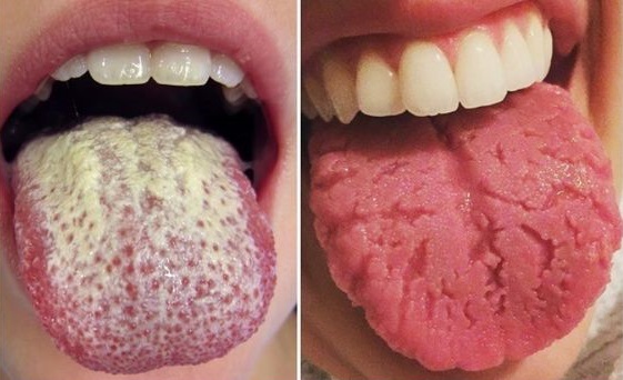 7 Tongue Disorders You Need to Beware of 7 Tongue Disorders You Need to Beware of