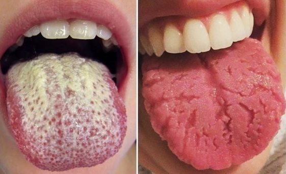 7 Tongue Disorders You Need to Beware of