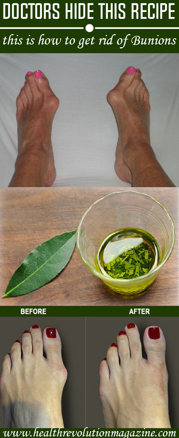 Doctors-Hide-This-Recipe-Here’s-How-to-Get-Rid-of-Bunions-Completely-Naturally1