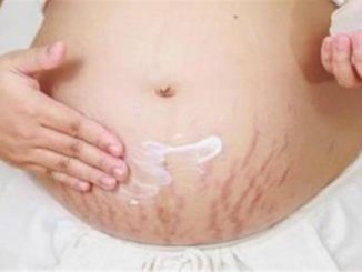 THIS SIMPLE LEMON TRICK WILL HELP YOU ELIMINATE STRETCH MARKS FOR GOOD