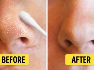 The Toothbrush Remedy To Get Rid Of Blackheads In A Few Minutes