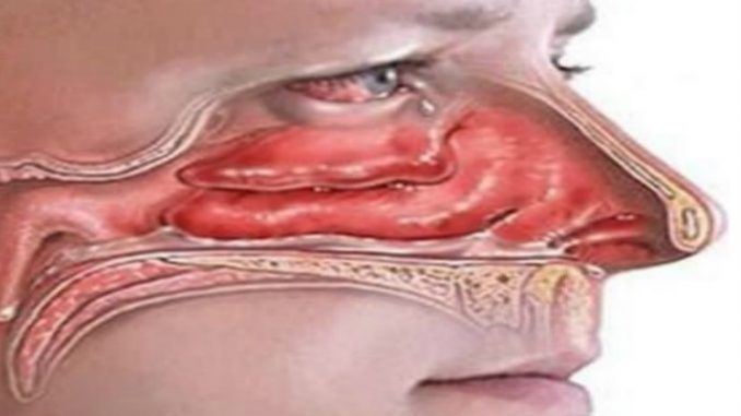 THIS SIMPLE REMEDY WILL GET RID OF ALL THE EXCESS PHLEGM FROM YOUR LUNGS AND THROAT