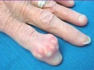 The Easiest and Quickest Way to Eliminate Uric Acid Crystallization From Your Body To Stop Gout And Joint Pain