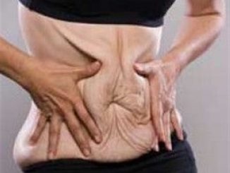 How to Get Rid of Loose Sagging Skin After Weight Loss