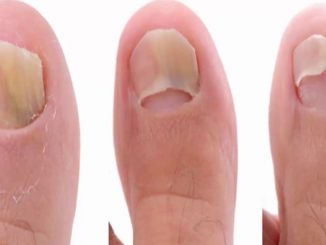 This Super Easy 2-Ingredient Recipe Will Eliminate Your Nail Fungus Forever