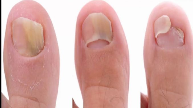 This Super Easy 2-Ingredient Recipe Will Eliminate Your Nail Fungus Forever