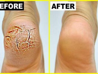 Grandma Told Me This Trick. It Healed My Cracked Heels In Just 1 Night