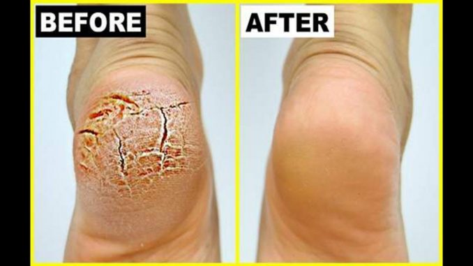 Grandma Told Me This Trick. It Healed My Cracked Heels In Just 1 Night