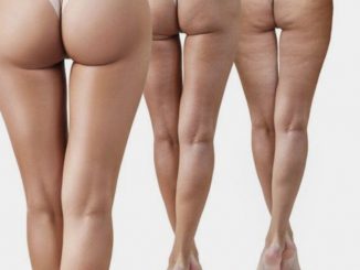 How To Get Rid Of Cellulite : The Definitive Guide