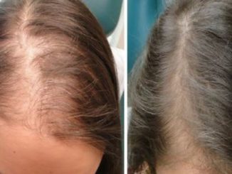 Ginger Hair Mask To Stop Hair Fall and Thinning Hair