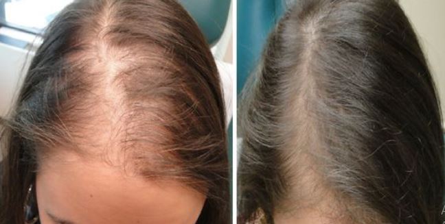 Ginger Hair Mask To Stop Hair Fall and Thinning Hair