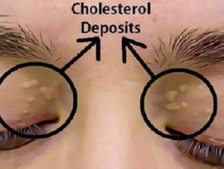 How to Remove the Cholesterol Deposits Around Your Eyes